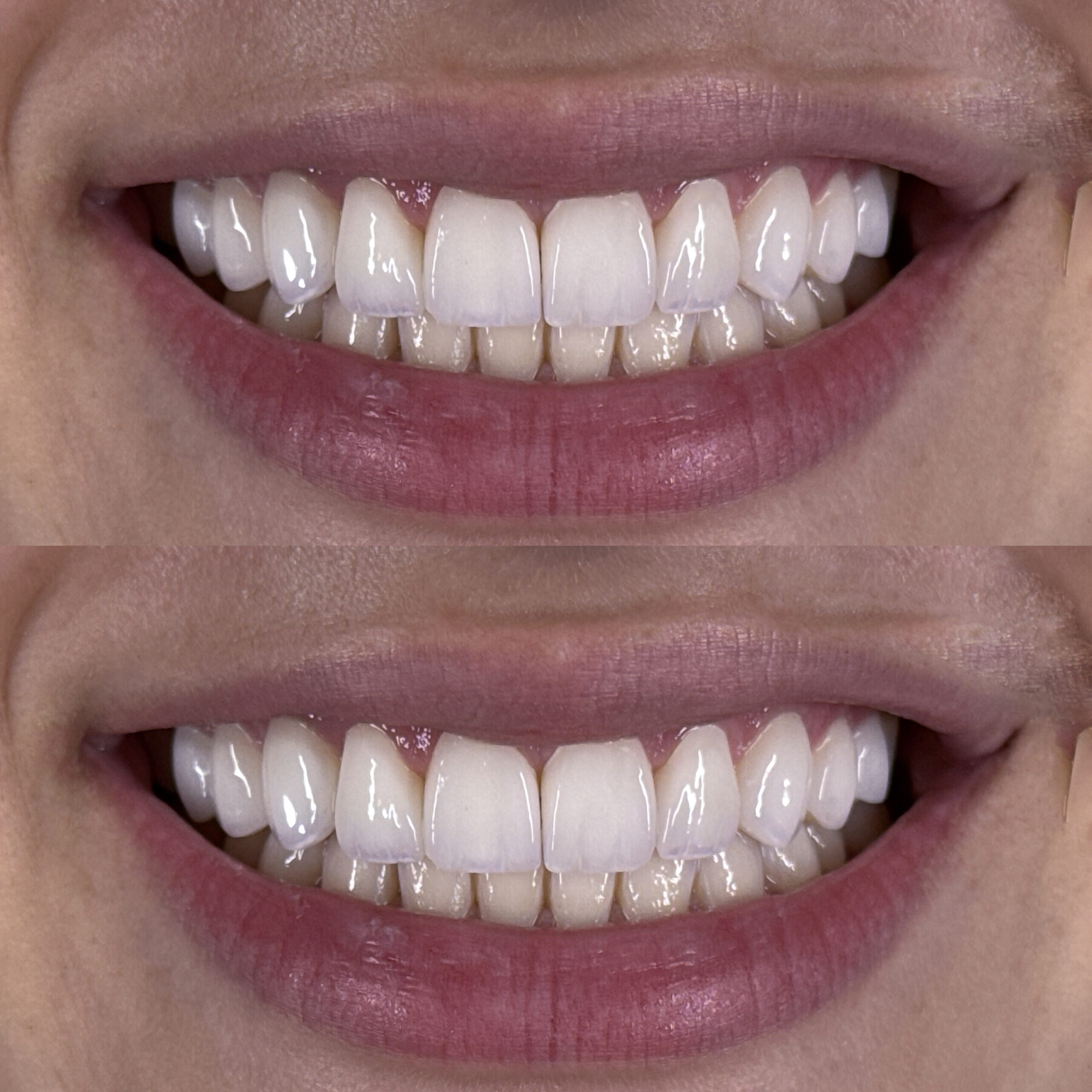 Diseño de sonrisa en porcelana premium